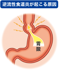 逆流性食道炎イラスト